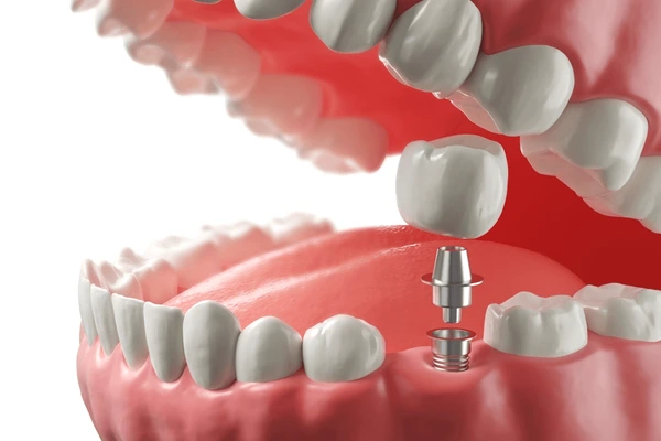 closeup-white-tooth-gum-dental-implant-600nw-2263536215